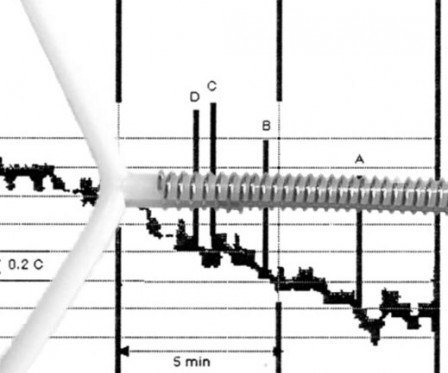 facfe3a27d-iud_procedure_in_time.jpg